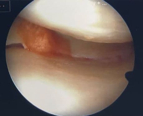 Arthroscopic view of the joint interior