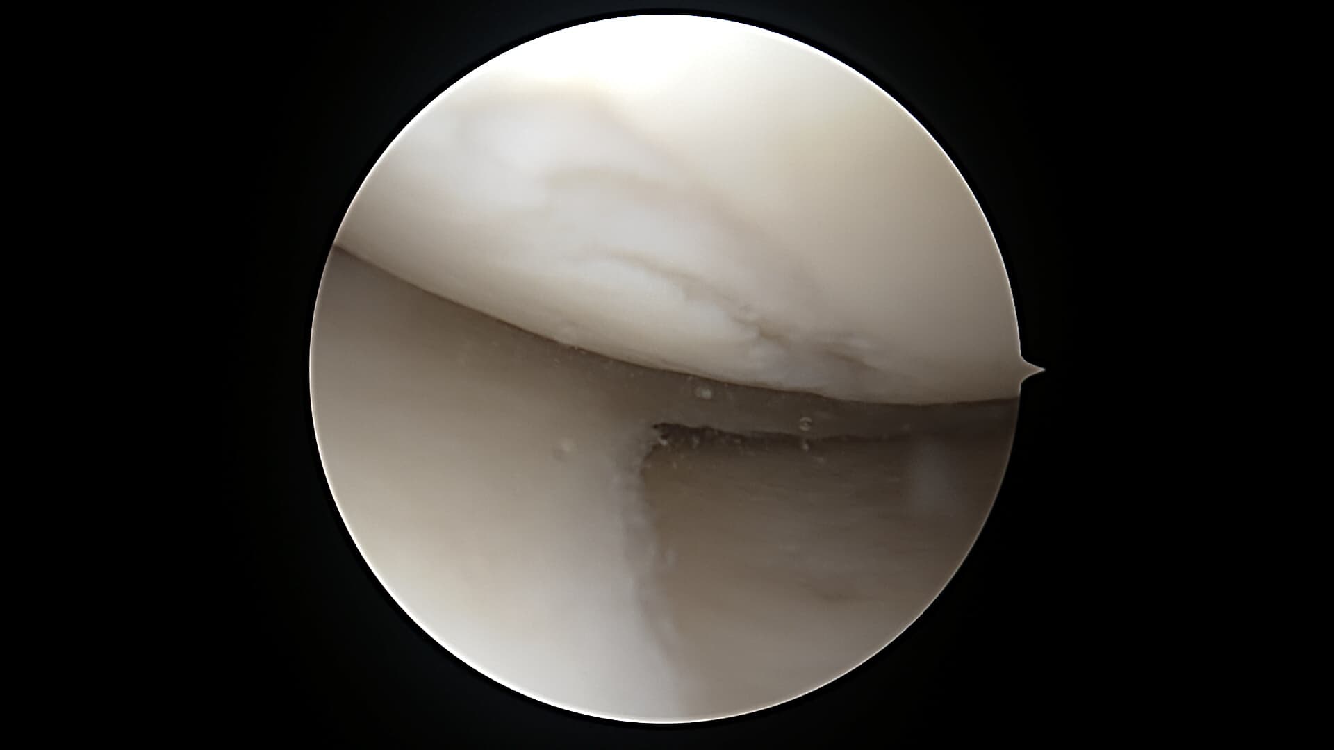 Cartilage damage adjacent to meniscus pathology