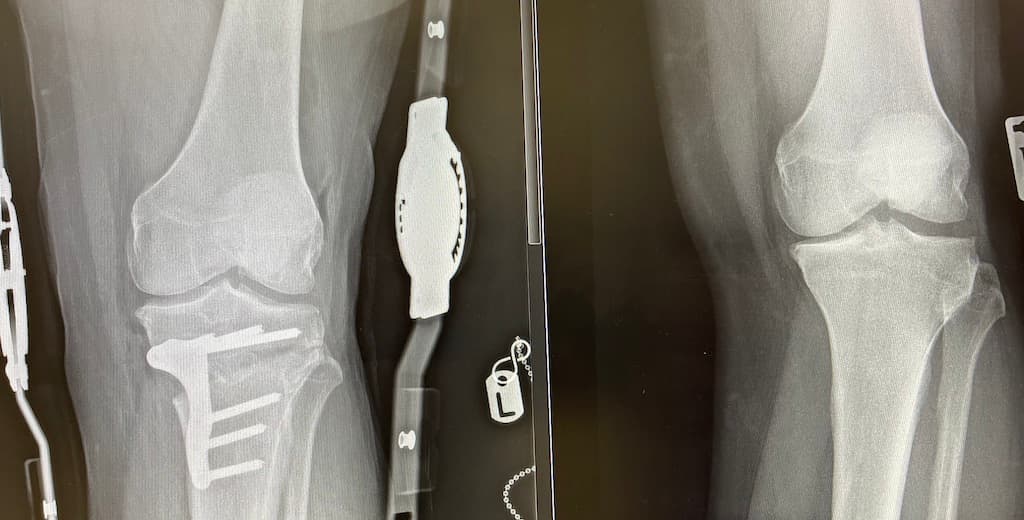 Hip and knee replacement, Professor Paul Lee