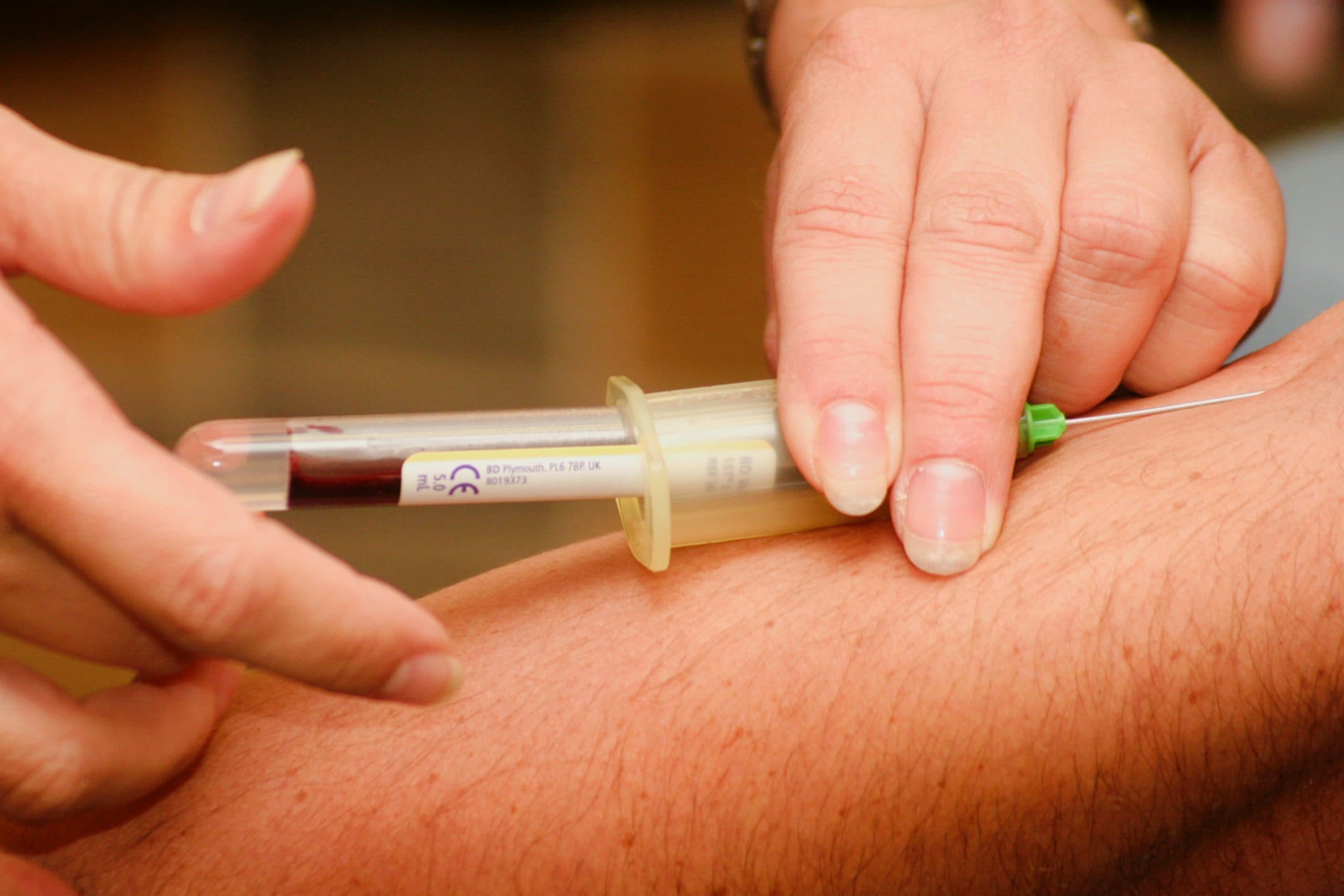 PRP (Platelet-Rich Plasma)